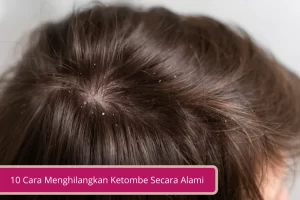 Gambar 10 Cara Menghilangkan Ketombe Secara Alami Yang Harus Kamu Coba