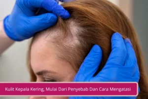 Gambar Semua Tentang Kulit Kepala Kering Mulai Dari Penyebab Dan Cara Mengatasi