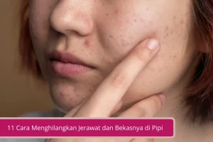 Gambar 11 Cara Menghilangkan Jerawat dan Bekasnya di Pipi