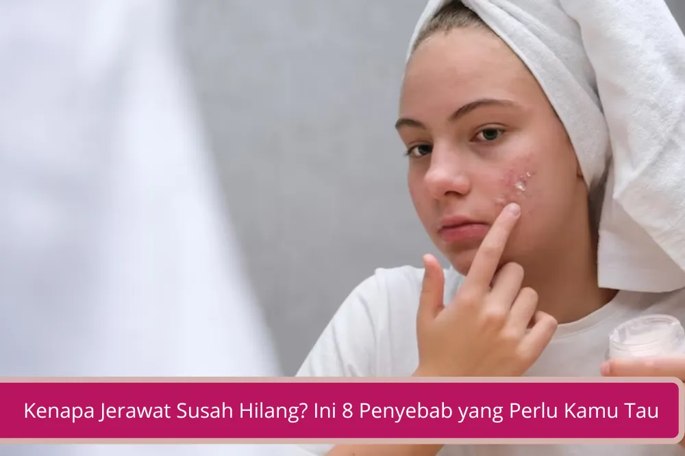 Gambar Kenapa Jerawat Susah Hilang Ini 8 Penyebab yang Perlu Kamu Tau