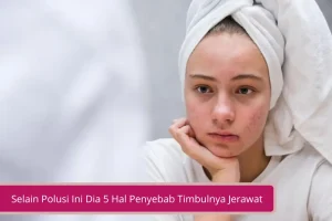 Gambar Selain Polusi Ini Dia 5 Hal Penyebab Timbulnya Jerawat dan Cara Menghilangkannya