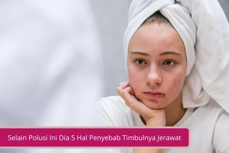 Gambar Selain Polusi Ini Dia 5 Hal Penyebab Timbulnya Jerawat dan Cara Menghilangkannya