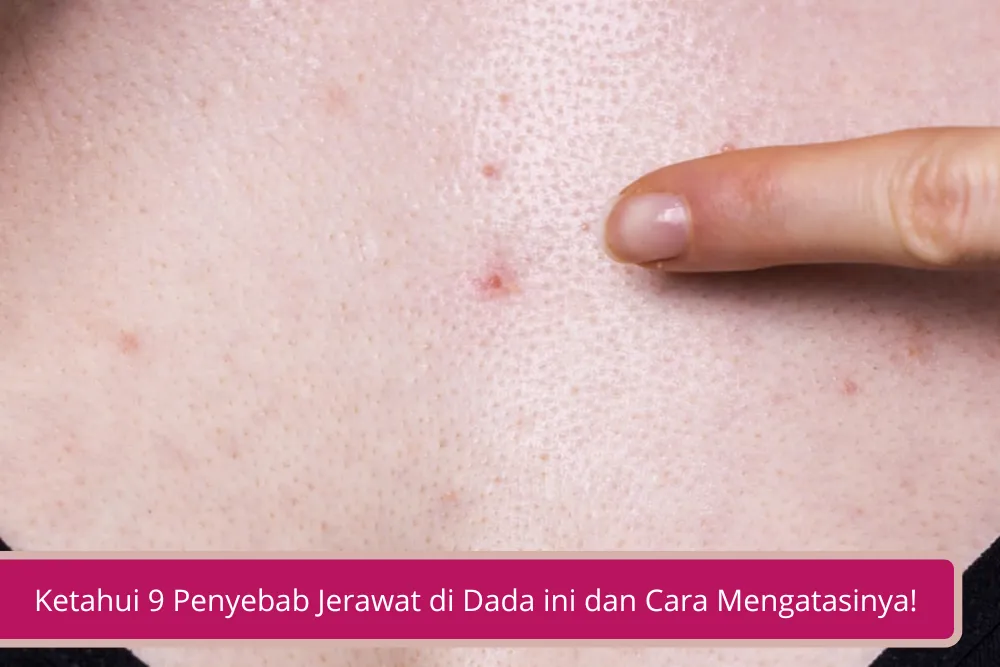 Gambar Ketahui 9 Penyebab Jerawat di Dada ini dan Cara Mengatasinya